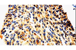 Immunohistochemistry of paraffin-embedded Human cervical cancer tissue using UTS2 Polyclonal Antibody at dilution 1:50 (Urotensin 2 Antikörper)