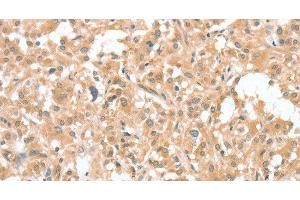 Immunohistochemistry of paraffin-embedded Human thyroid cancer using CIAPIN1 Polyclonal Antibody at dilution of 1:60 (CIAPIN1 Antikörper)