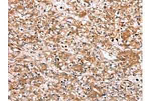 The image on the left is immunohistochemistry of paraffin-embedded Human prostate cancer tissue using ABIN7192440(SLC25A20 Antibody) at dilution 1/30, on the right is treated with synthetic peptide. (SLC25A2 Antikörper)