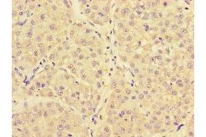 Immunohistochemistry of paraffin-embedded human liver cancer using ABIN7144725 at dilution of 1:100 (NARS Antikörper  (AA 1-300))