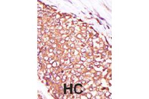 Formalin-fixed and paraffin-embedded human hepatocellular carcinoma tissue reacted with PRKCQ polyclonal antibody  , which was peroxidase-conjugated to the secondary antibody, followed by DAB staining . (PKC theta Antikörper  (C-Term))