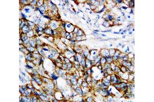 Anti-beta Catenin antibody,  IHC(P) IHC(P): Human Mammary Cancer Tissue (CTNNB1 Antikörper  (C-Term))