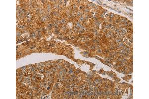 Immunohistochemistry of Human ovarian cancer using PRDX3 Polyclonal Antibody at dilution of 1:50