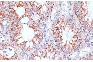 Immunohistochemistry of paraffin-embedded Human colon carcinoma using HIGD1A Polyclonal Antibody at dilution of 1:100 (40x lens).