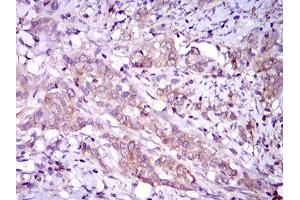 Immunohistochemical analysis of paraffin-embedded cervical cancer tissues using MAPK14 mouse mAb with DAB staining. (MAPK14 Antikörper  (AA 299-360))