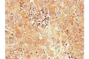 Immunohistochemistry of paraffin-embedded human liver cancer using ABIN7147128 at dilution of 1:100 (CD177 Antikörper  (AA 22-321))
