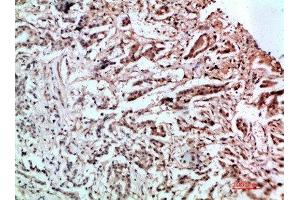 Immunohistochemical analysis of paraffin-embedded human-stomach-cancer, antibody was diluted at 1:200 (L1CAM Antikörper  (AA 151-200))