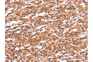 The image on the left is immunohistochemistry of paraffin-embedded Human thyroid cancer tissue using ABIN7190731(GABRA1 Antibody) at dilution 1/30, on the right is treated with synthetic peptide. (GABRA1 Antikörper)