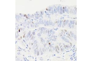 Immunohistochemistry of paraffin-embedded human colon carcinoma using [KO Validated] p53 Rabbit mAb (ABIN7271080) at dilution of 1:100 (40x lens). (p53 Antikörper)