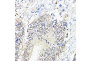 Immunohistochemistry of paraffin-embedded human colon carcinoma using GPX2 antibody (ABIN7267435) at dilution of 1:100 (40x lens). (Glutathione Peroxidase 2 Antikörper  (AA 100-180))