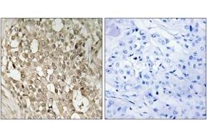 Immunohistochemistry analysis of paraffin-embedded human breast carcinoma, using NF-kappaB p65 (Phospho-Ser529) Antibody.