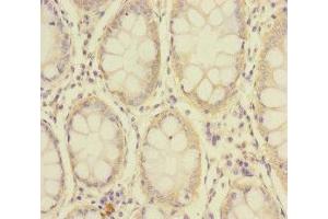 Immunohistochemistry of paraffin-embedded human colon cancer using ABIN7176692 at dilution of 1:100 (SLC39A7 Antikörper  (AA 235-380))
