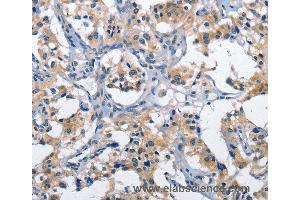 Immunohistochemistry of Human thyroid cancer using CLEC2D Polyclonal Antibody at dilution of 1:60 (CLEC2D Antikörper)
