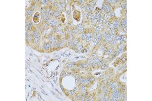 Immunohistochemistry of paraffin-embedded human colon carcinoma using PSG1 antibody (ABIN5973801) at dilution of 1/100 (40x lens). (PSG1 Antikörper)