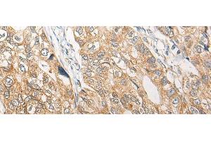 Immunohistochemistry of paraffin-embedded Human gastric cancer tissue using RGN Polyclonal Antibody at dilution of 1:25(x200) (Regucalcin Antikörper)