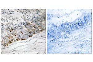 Immunohistochemistry analysis of paraffin-embedded human colon carcinoma tissue using GCHFR antibody. (GCHFR Antikörper  (Internal Region))