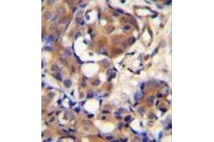 Immunohistochemistry analysis in formalin fixed and paraffin embedded human breast carcinoma reacted with Kininogen-1 Antibody (N-term) followed which was peroxidase conjugated to the secondary antibody and followed by DAB staining.