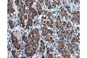 Immunohistochemical staining of paraffin-embedded Carcinoma of liver tissue using anti-PSMC3 mouse monoclonal antibody. (PSMC3 Antikörper)