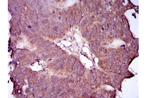 Immunohistochemical analysis of paraffin-embedded rectum cancer tissues using EGFR mutant mouse mAb with DAB staining. (EGFR Mutant (AA 693-893) Antikörper)