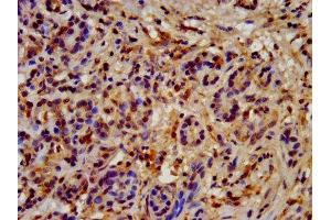 IHC image of ABIN7154923 diluted at 1:200 and staining in paraffin-embedded human pancreatic cancer performed on a Leica BondTM system. (HSP9AB1 (AA 150-355) Antikörper)