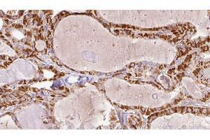ABIN6267203 at 1/100 staining Human thyroid cancer tissue by IHC-P. (Tuberin Antikörper  (pSer1387))