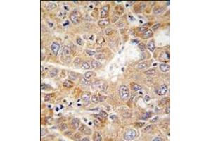 Formalin-fixed and paraffin-embedded human hepatocarcinoma tissue reacted with PGK1 antibody (Center), which was peroxidase-conjugated to the secondary antibody, followed by DAB staining. (PGK1 Antikörper  (Middle Region))