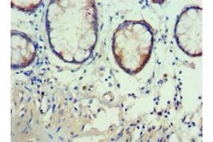 Immunohistochemistry of paraffin-embedded human colon cancer using ABIN7142909 at dilution of 1:100 (AKAP5 Antikörper  (AA 1-270))