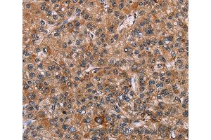 Immunohistochemistry of Human liver cancer using EGR4 Polyclonal Antibody at dilution of 1:20