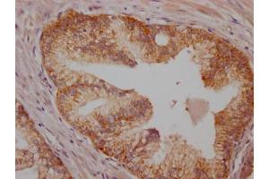 IHC image of ABIN7127359 diluted at 1:100 and staining in paraffin-embedded human prostate cancer performed on a Leica BondTM system. (Rekombinanter BRAF Antikörper)