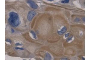 IHC-P analysis of Human Colorectal cancer Tissue, with DAB staining. (GDF11 Antikörper  (AA 138-386))