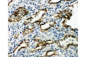 IHC-P: Aquaporin 4 antibody testing of human lung cancer tissue (Aquaporin 4 Antikörper  (AA 258-27))