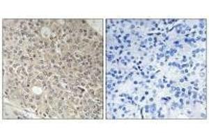 Immunohistochemistry analysis of paraffin-embedded human prostate carcinoma tissue using AMOTL1 antibody. (AMOTL1 Antikörper)