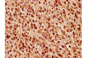 IHC image of ABIN7166287 diluted at 1:200 and staining in paraffin-embedded human glioma performed on a Leica BondTM system. (WIZ Antikörper  (AA 1469-1574))