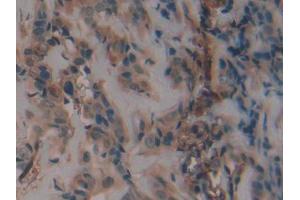 DAB staining on IHC-P; Samples: Human Breast cancer Tissue (PAI1 Antikörper  (AA 25-402))