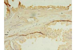 Immunohistochemistry of paraffin-embedded human prostate cancer using ABIN7162127 at dilution of 1:100 (OCIAD1 Antikörper  (AA 1-245))