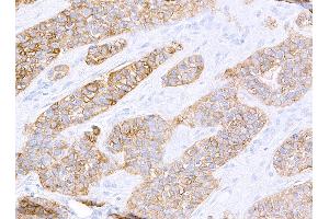 Immunohistochemistry (IHC) image for anti-Receptor tyrosine-protein kinase erbB-2 (ErbB2/Her2) (AA 1205-1255) antibody (ABIN7455181) (Rekombinanter ErbB2/Her2 Antikörper  (AA 1205-1255))