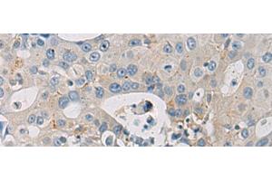 Immunohistochemistry of paraffin-embedded Human breast cancer tissue using WFDC3 Polyclonal Antibody at dilution of 1:40(x200) (WFDC3 Antikörper)