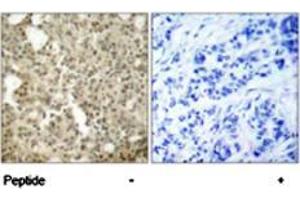 Immunohistochemical analysis of paraffin-embedded human breast carcinoma tissue using PRKCD polyclonal antibody  . (PKC delta Antikörper)