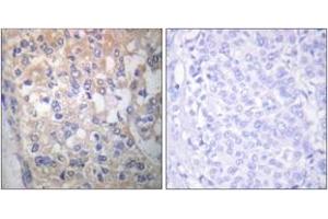 Immunohistochemistry analysis of paraffin-embedded human breast carcinoma, using Fyn (Phospho-Tyr530) Antibody. (FYN Antikörper  (pTyr531))