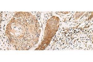 Immunohistochemistry of paraffin-embedded Human esophagus cancer tissue using EXD2 Polyclonal Antibody at dilution of 1:55(x200) (EXD2 Antikörper)