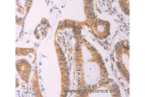 Immunohistochemistry of Human liver cancer using ADCY1 Polyclonal Antibody at dilution of 1:60 (ADCY1 Antikörper)