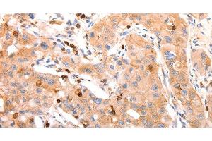 Immunohistochemistry of paraffin-embedded Human lung cancer tissue using CELSR2 Polyclonal Antibody at dilution 1:50 (CELSR2 Antikörper)