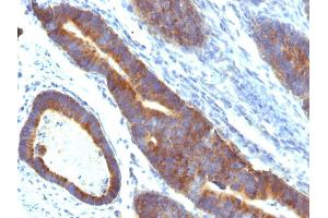 Formalin-fixed, paraffin-embedded human Colon Carcinoma stained with MUC3 Monoclonal Antibody (MUC3/1154). (MUC3A Antikörper)