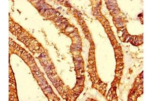 Immunohistochemistry of paraffin-embedded human endometrial cancer using ABIN7142242 at dilution of 1:100 (Putative Mitochondrial Ribosomal Protein S1 (MRPS1) (AA 1-201) Antikörper)