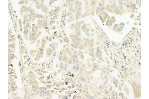 ABIN6261918 and ABIN6278469 at 1/100 staining human lung squamous cell carcinoma by IHC-P. (GUCY1B2 Antikörper  (C-Term))