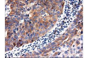 Immunohistochemical staining of paraffin-embedded Carcinoma of Human kidney tissue using anti-ALDH1L1 mouse monoclonal antibody. (ALDH1L1 Antikörper)