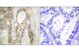 Immunohistochemistry analysis of paraffin-embedded human colon carcinoma, using Chk1 (Ab-296) Antibody. (CHEK1 Antikörper  (AA 266-315))