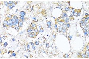 Immunohistochemistry of paraffin-embedded Human breast cancer using TIMP2 Polyclonal Antibody at dilution of 1:150 (40x lens). (TIMP2 Antikörper)