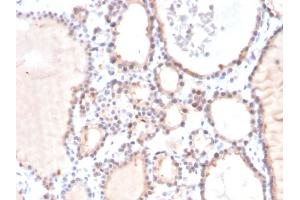 Formalin-fixed, paraffin-embedded human Prostate Carcinoma stained with Lactoylglutathione Lyase Mouse Monoclonal Antibody (CPTC-GLO1-3). (GLO1 Antikörper)