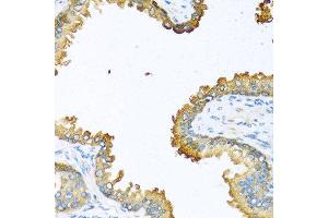 Immunohistochemistry of paraffin-embedded human prostate using VEGFC antibody at dilution of 1:100 (40x lens). (VEGFC Antikörper)